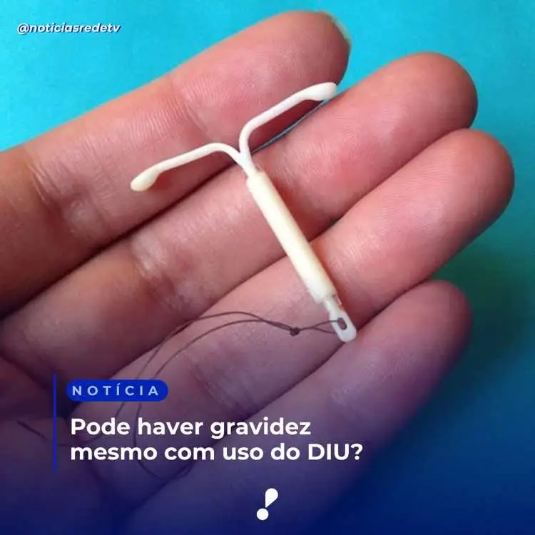 A influenciadora digital Débora Paixão, de 22 anos, surpreendeu seus seguidores ao anunciar que está grávida de seu quarto filho. Isso por que a influenciadora faz uso do DIU (Dispositivo Intrauterino), considerado um dos métodos contraceptivos mais eficazes.   Ao responder uma seguidora que questionou como a gravidez foi possível, mesmo com o uso do contraceptivo, ela explicou: “Eu estava com o DIU e, por incrível que pareça, eu engravidei com o DIU. Para as meninas que usam Mirena, cuidado.”.   Embora raro, a falha do DIU pode ocorrer, conforme explicou a ginecologista e obstetra Dra. Ana Luiza Pace. “O DIU é altamente eficaz, com taxas de falha de 0,1% a 0,8%, dependendo do tipo. Contudo, deslocamentos, expulsões ou posicionamento inadequado podem comprometer sua eficácia. É fundamental que as mulheres realizem consultas regulares para verificar o posicionamento do dispositivo e fiquem atentas a sintomas como dor abdominal persistente ou sangramentos irregulares.”. . . . Texto: Redação RedeTV! Reprodução: Redes Sociais Foto 3: Michelle Oliveira/Divulgação #news #jornalismo #noticias #informação #redetv #info #diu #gravidez #contraceptivo #ginecologista 