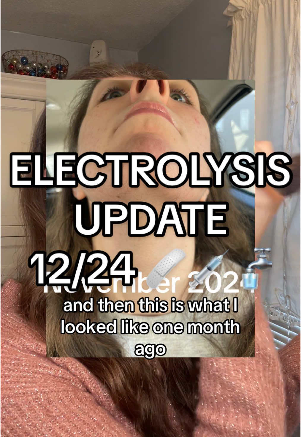 An electrolysis update for my electrolysis permanent hair removal for my facial hair on my chin. Updates on growth, ingrown hairs, and my cleansing routine. #electrolysis #electrolysisupdate #hairremoval #permanenthairremoval #femalefacialhair #electrolysishairremoval #skincare 