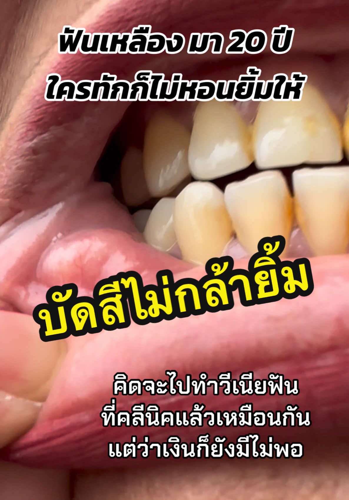 เพราะเชื่อเพื่อน #ยาสีฟันขิงขิง #รีวิวบิวตี้ #ฟันขาว #หมูน้อยรีวิว  @หมูน้อยรีวิว  @หมูน้อยรีวิว  @หมูน้อยรีวิว 