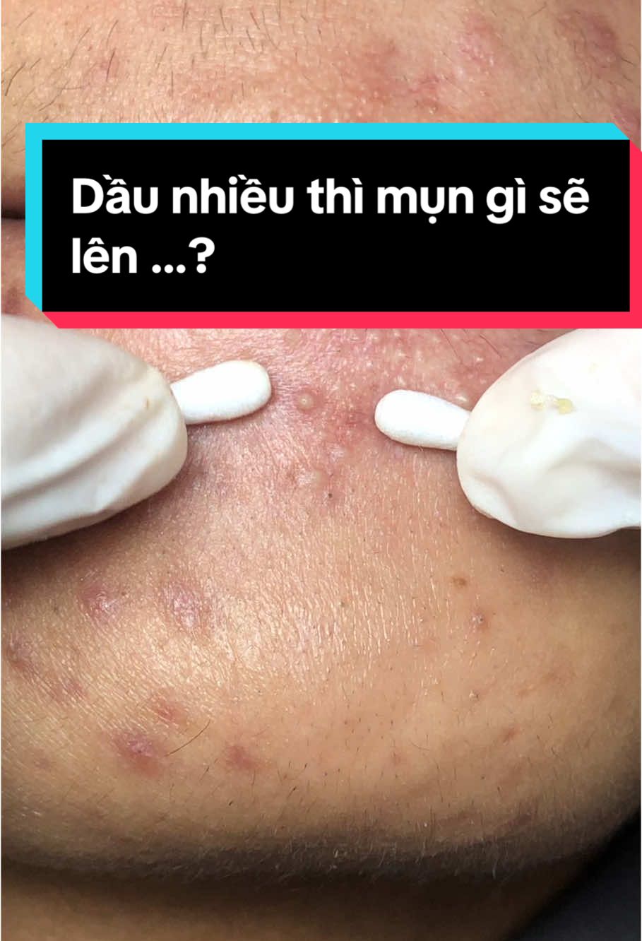 Muốn hết mụn thì nên làm gì? #cleohouse #trimun #nanmunuytintphcm #peelda #xuhuong 