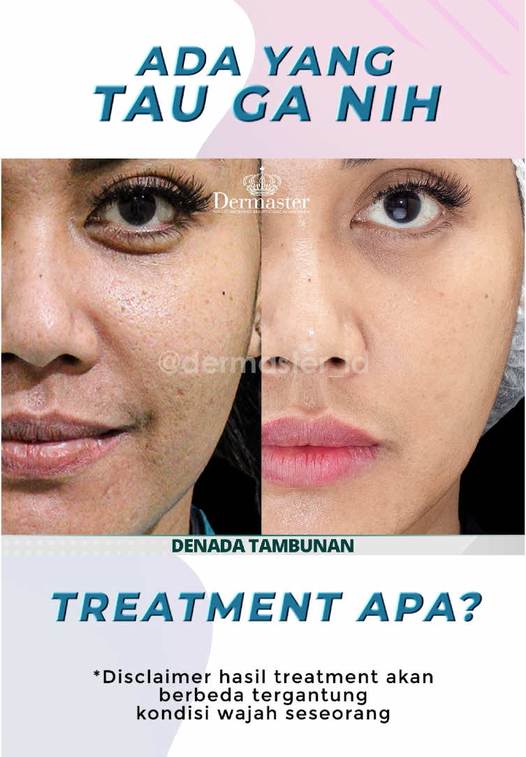 Wajar banget loh punya tekstur kulit dan pori-pori besar!🥹 Tapi kalau bisa punya wajah mulus kenapa ngga?🥰 Sekali treatment Fractional RF Laser kalian bisa dapat 5 solusi🤩 Cuss booking appointment sekarang! #fyp #dermasterid #sempurnabydermaster #semuabisacakep #treatment #fractionalrflaser #fractional #lasertreatment #bopeng #poribesar #aging #denada #transformasi #xyzbca 