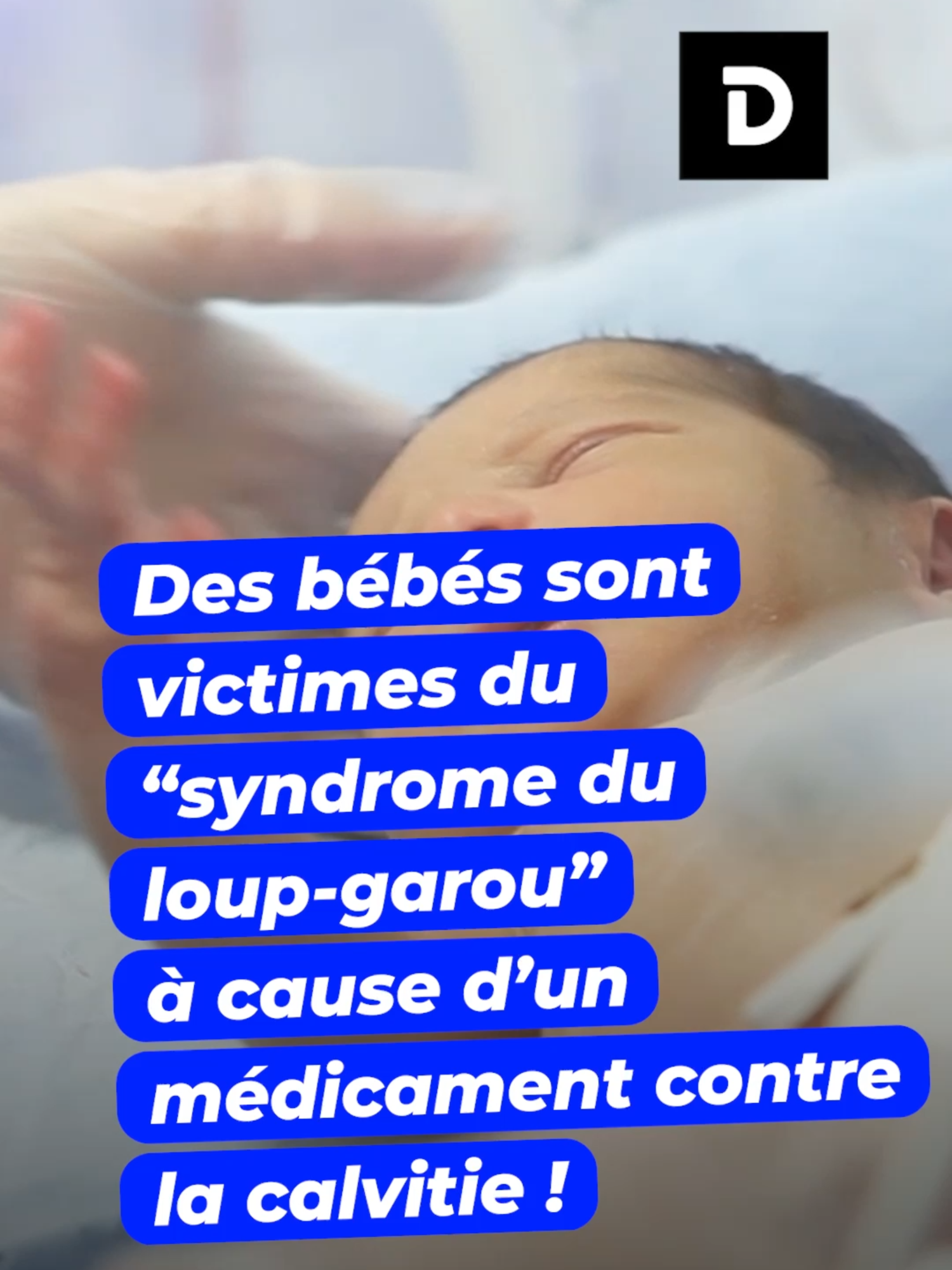 Des bébés sont victimes du “syndrome du loup-garou” à cause d’un médicament contre la calvitie ! #babiesoftiktok #bebes #santé