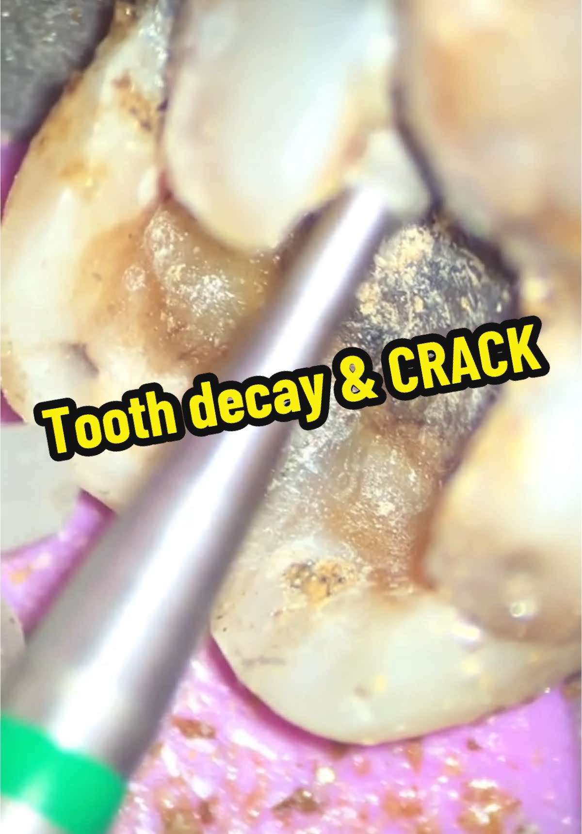 Removal of big amalgam restauration and removing decay under 40X magnification with microscope 🔬 What would be your treatment plan for this tooth?  #amalgam #excavation #microscope #microscopedentistry #decay #tooth #teeth #caries #toothdecay #crackedtooth #crack #fy #fyp #foryou #foryoupage #fypage #fyppppppppppppppppppppppp #fypシ゚ #tiktokdentist #dentist #dentistry #dentalstudent 