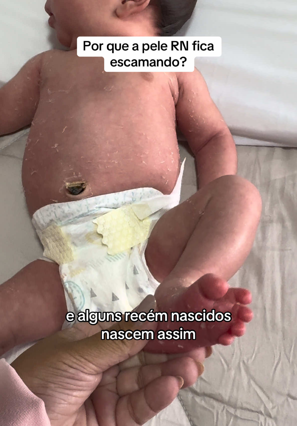 Pele escamando do recém-nascido? 🍼✨ Aqui a Maitê estava com 8 dias e a pele ainda descamava bastante. Isso acontece porque, dentro do útero, o bebê estava envolvido pelo vernix caseoso, aquela camada protetora que hidrata a pele. Após o nascimento, a pele começa a se adaptar ao ambiente externo e perde essa proteção natural, resultando na descamação. É algo normal e temporário, não precisa se preocupar! Evite esfregar a pele e mantenha-a hidratada com produtos indicados pelo pediatra. 🌸 Compartilhe 🚀 🎤A pele do seu bebê também ficou assim, após o nascimento? Conte para mim #RecémNascido #PeleDoBebê #BoaGravidez #MaternidadeReal #CuidadosComOBebê #PatriciaMoreira #Nutrigeston 