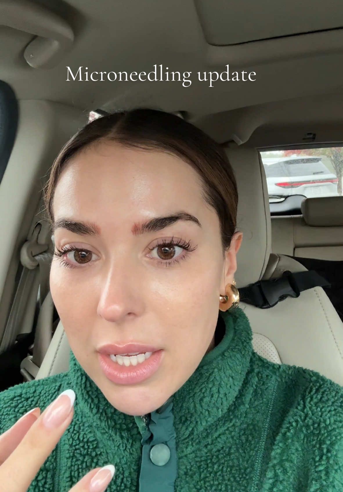 microneedling removal update! #microneedling 