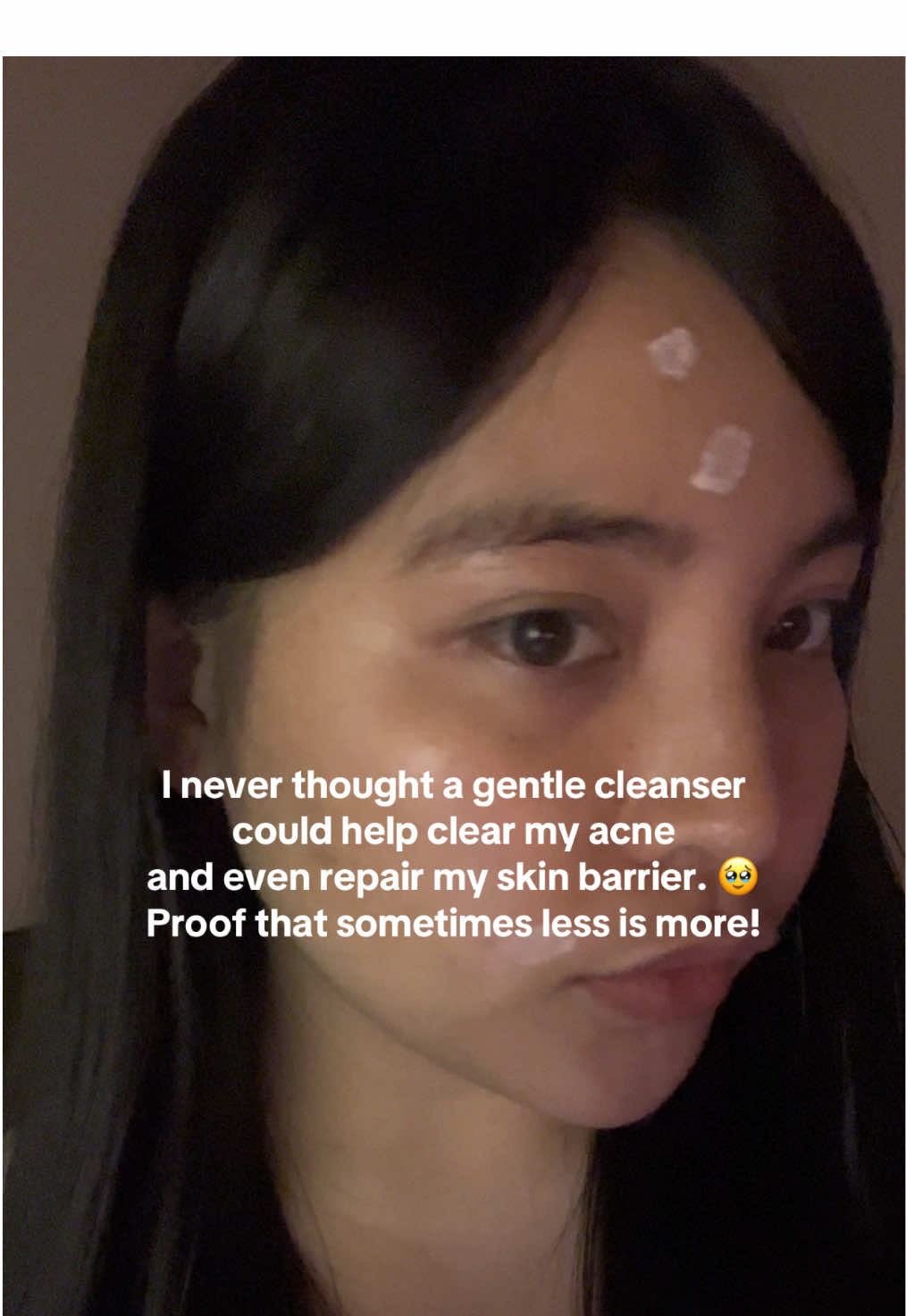 Forever grateful for this gentle cleanser! It’s a game-changer for my skin! clearing acne and repairing my skin barrier. Proof that sometimes less is more! 🥹🩷 #acnejourney #acnetips #pimplepop #skincare #acnesolution #clearskin #acneproblems #pimplepatch #acnetreatment #skincareroutine #blemishes #acne #foryoupage #acneskin #sensitiveskin #guthealth #clearskintips #glassskintips #acnefighter #acnesurvivor #acnetransformation #skin #selfimprovement #skintok #fyp #tipsaccount #creatorsearchinsights #warts #wartsremoval #acnefacial #creatorsearchinsights 