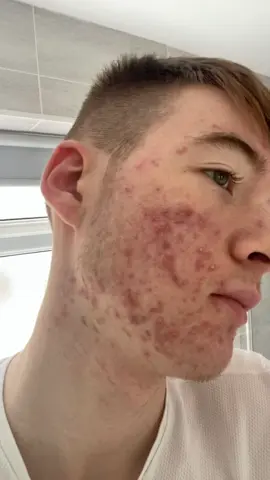 Acne has traumered me for around 7 years now ever since i was 14 and has been unbearable for my confidence, every day whenever i seen a murror i would look into it and just see if anything has changed (nothing did). Multiple medication from dermatologists and skincare products from a friend couldnt help so one last option saved me which was accutane, it has the most severe effects but if you get through it, it works wonders, i still have to use skincare twice a day but now i feel like a different person and so much better. #acne #accutanejourney 