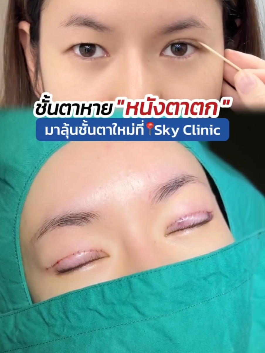 ชั้นตาหาย หนังตาตก มาลุ้นชั้นตาใหม่ที่ #skyclinic 👁😲 #หมอสกาย #จักษุแพทย์ #รีวิวทำตาสองชั้น #ทําตาที่ไหนดี #ศัลยกรรมตา #สกายคลินิก #sweeteyes #ศัลยกรรมเปลี่ยนชีวิต #ทำตาสองชั้น 