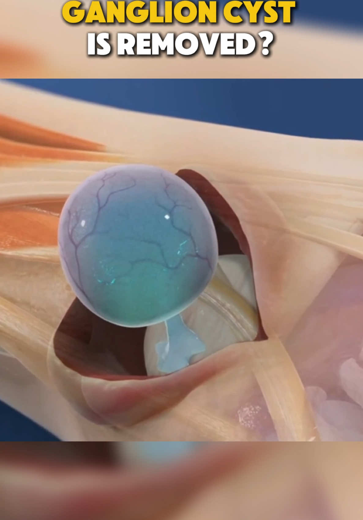 How Ganglion Cyst Is Removed? 3D Animation #ganglioncyst #ganglion #ganglioncysttreatment #cyst #cystremoval #cysttreatment #medical3danimation #3dmedicalanimation #ganglion