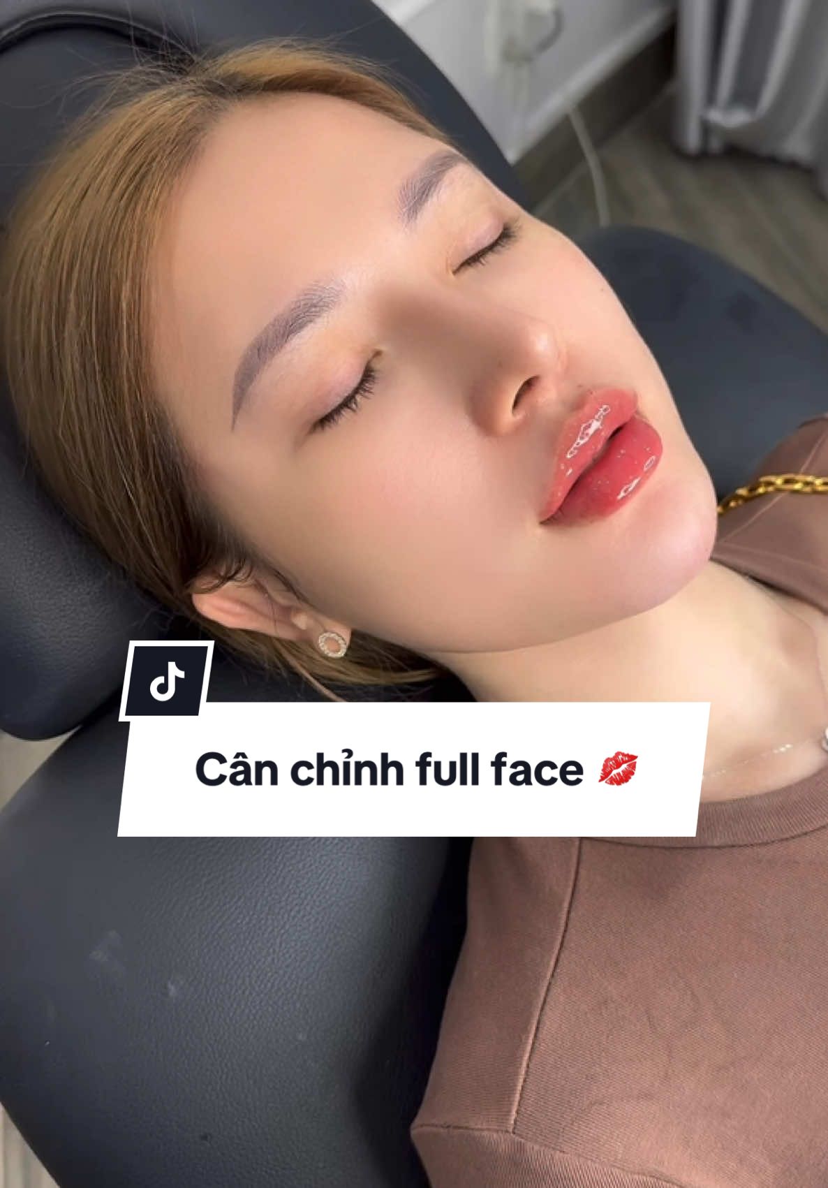 KHÁCHH CÂN CHỈNH FULL FACE NHÀ #ANNIE , MÔI + CÀM + THÁI DƯƠNG + RẢNH CƯỜI + MÁ BABY + GỌN HÀM VIP CỘNG THÊM CHIẾC DA CHĂM TIÊMM MESO + BAP NÂNG CƠ MỎI THÁNG LUÔN Ạ 💯💯😍😍😍😍😍