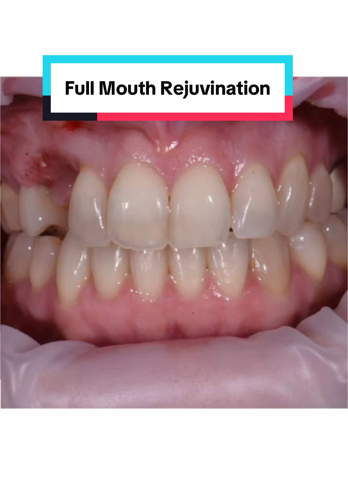 #beforeandafter #fullmouthrestoration #veneers #veneer 