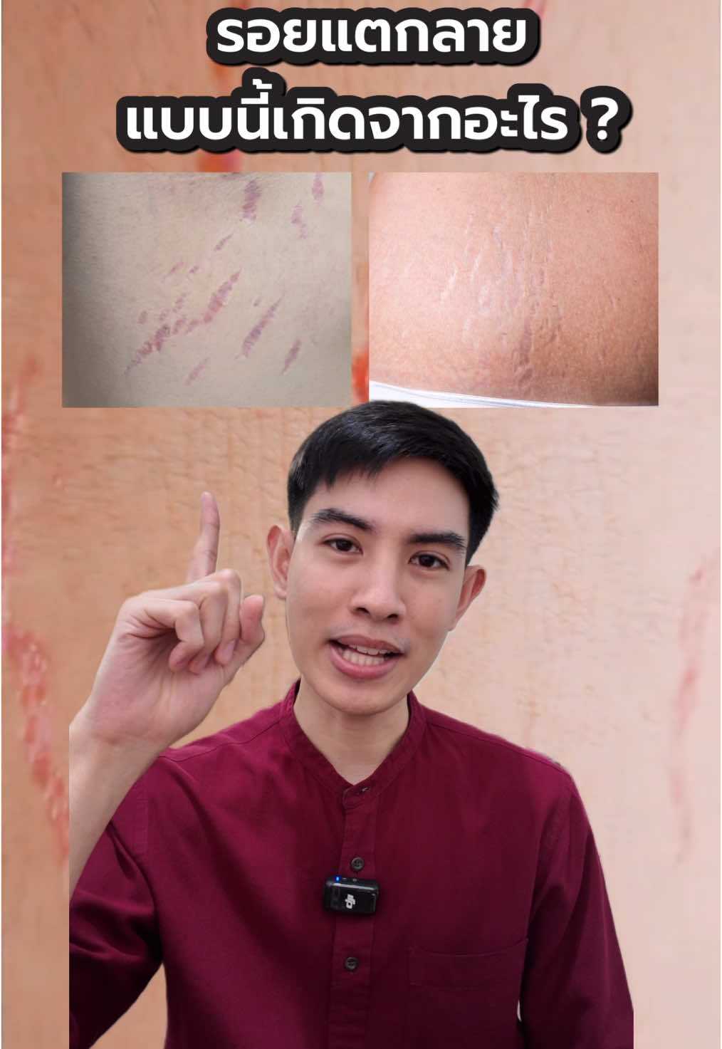 ผิวแตกลายแบบนี้ เกิดจากอะไร ? #tiktokuni #รู้จากtiktok #bestpeerasaran #pharmacist #เภสัชกร #stretchmarks #สุขภาพดี