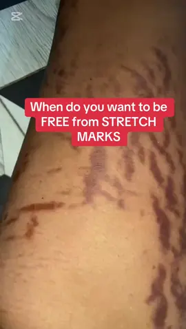 She said, I am seeing better results for what i am fighting for.  She had tried different products before meeting us, She had been on this issue for Years and now, in just 6 weeks and 3 days.  She is seeing better results  Do you know someone having stretch marks, Repost this, Share this for them to see.  We will be starting stretch marks consultation soonest.  #yinderm #stretchmarks #stretchmarkremoval 