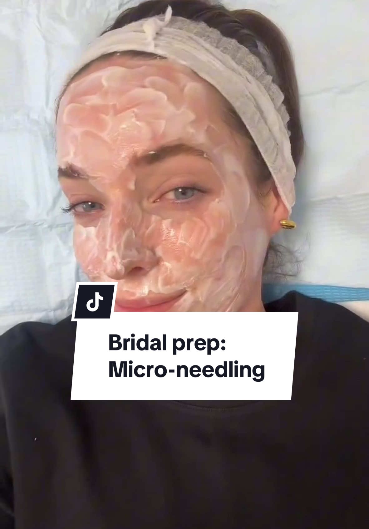 Replying to @sarah Bridal Beauty Prep diaries 👰🏻‍♀️🫧 micro-needling with Renew Clinic 💉 I found it amazing for my skin texture and pore-size, have you tried it before? 🤍Follow along for my wedding glow up series where I bring you through all the makeup hair and beauty treatments (& tweakments!) I’ve been doing as part of my maintenance routine, and in the lead up to the big day 🤍 ad pr treatment #renewclinic #microneedling #microneedlingtherapy #bridalprep #bridalskin #bridalbeautyprep