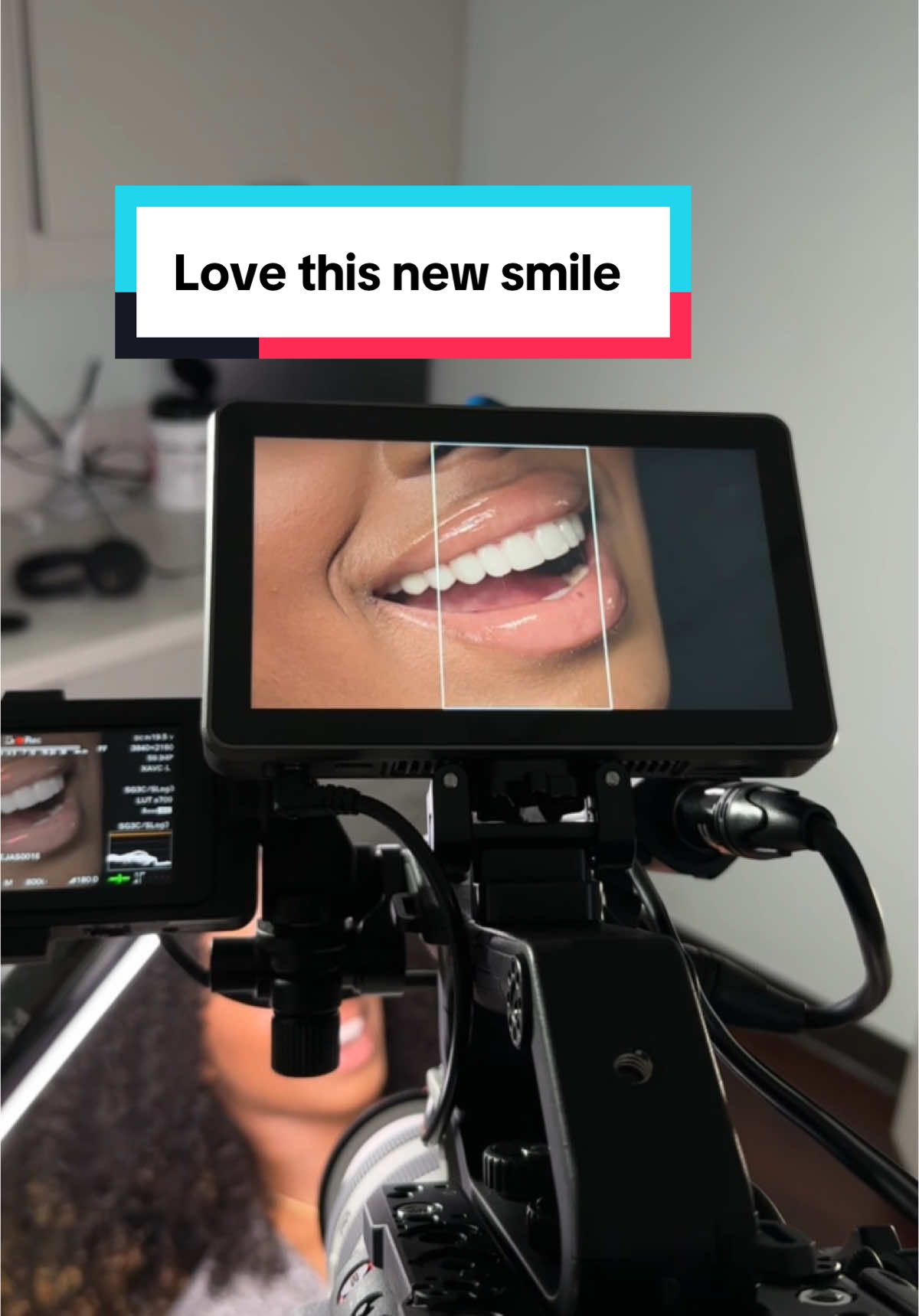 #newsmile #veneers #noprepveneers 