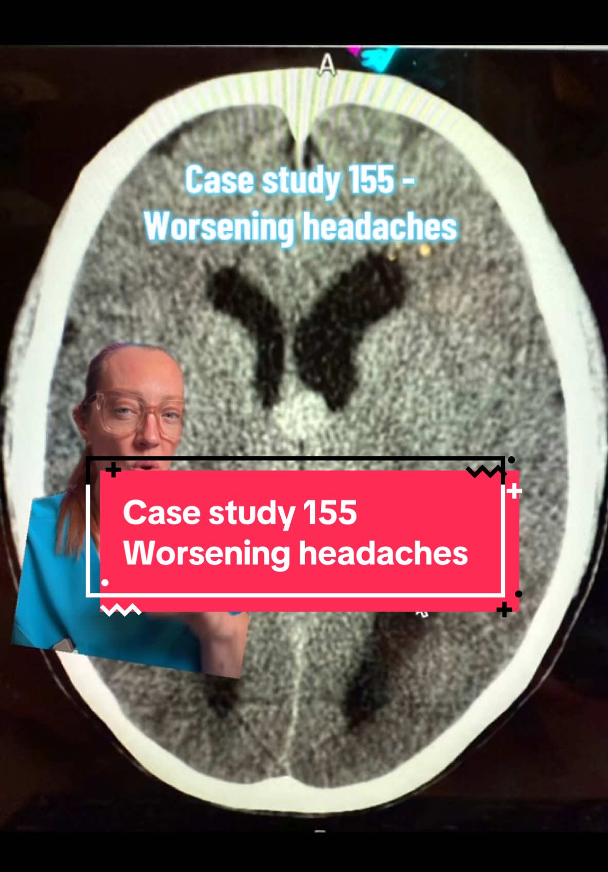 Case Study 155 - worsening headaches  A 39-year-old female presents to the emergency department with acutely worsening headaches. She has a history of migraines, but her headaches have gotten much worse in the past two weeks. Her CAT scan is shown. What is the diagnosis? What is the treatment? Stay tuned tomorrow and I’ll explain whole case. #sundaycasestudy  #ladyspinedoc #healthcareworker #hospital #surgery #neurosurgeon #medicalschool #medstudent #medicalstudent #nursing #migraine #headache 