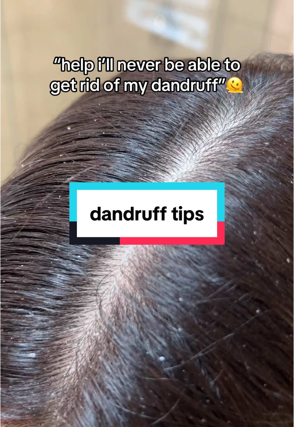 dandruff living rent-free on my scalp is a NO✋ #dandrufftreatment #dandruffremoval #scalpexfoliation #scalphealthtips