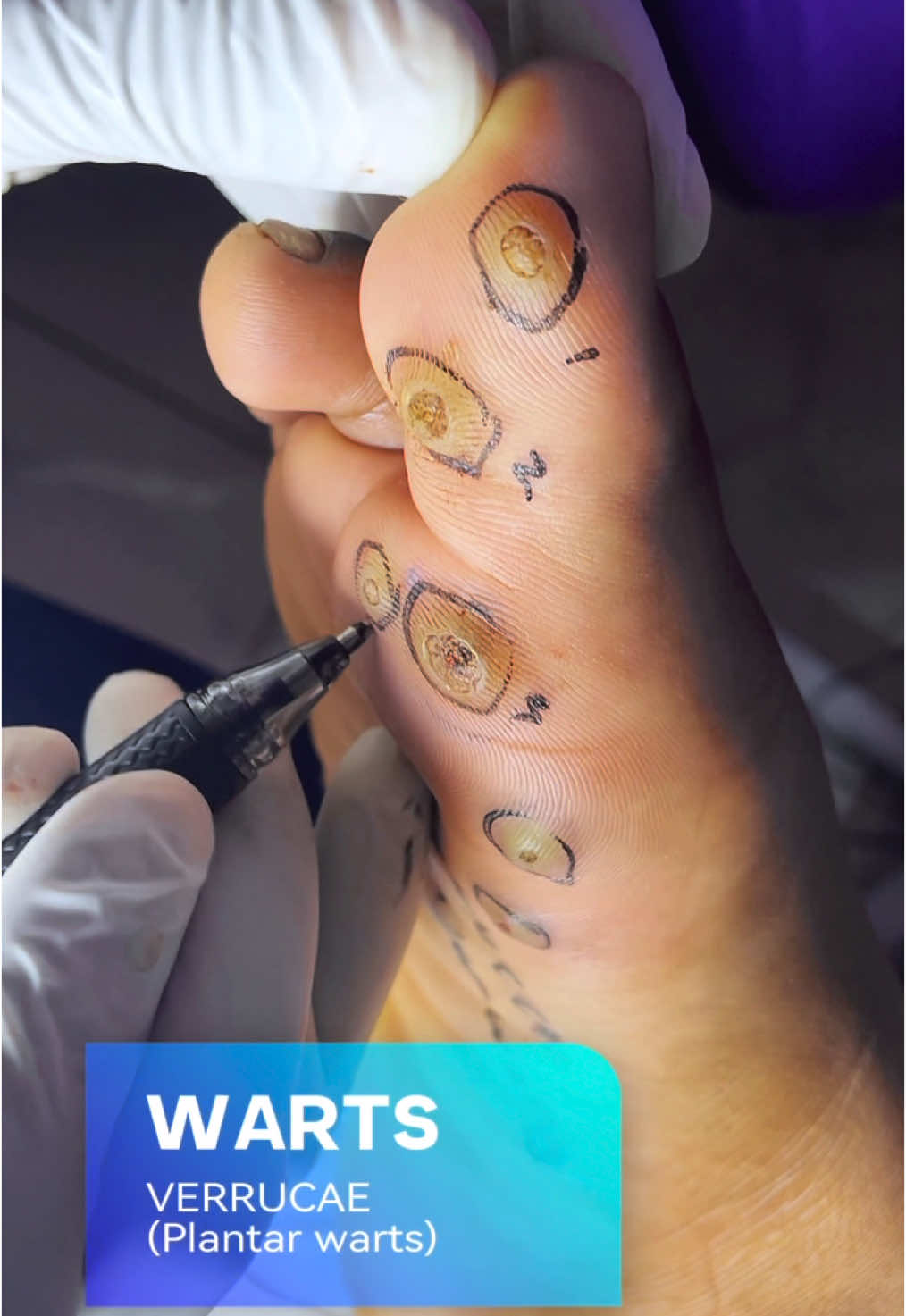 Plantar warts are caused by an infection with HPV in the outer layer of skin on the soles of the feet. The warts develop when the virus enters through tiny cuts, breaks or weak spots on the bottom of the foot. #warts #plantarwarts #plantarwartsonfeet #plantarwartsremoval #skindictionary 