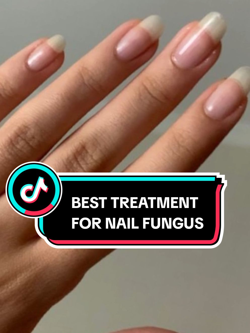 How to treat nail fungus naturally. How to treat nail fungus at home. How to treat nail fungus with garlic, vinegar and baking soda. #nail #nailfungus #nailfungustreatment #naturalremedy #naturalrecipes 