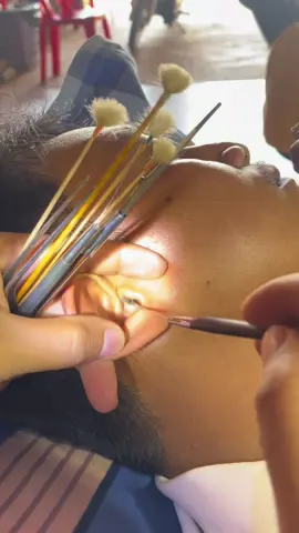 #cleaning #removal #ear #earwaxremoval #follow #waxear 