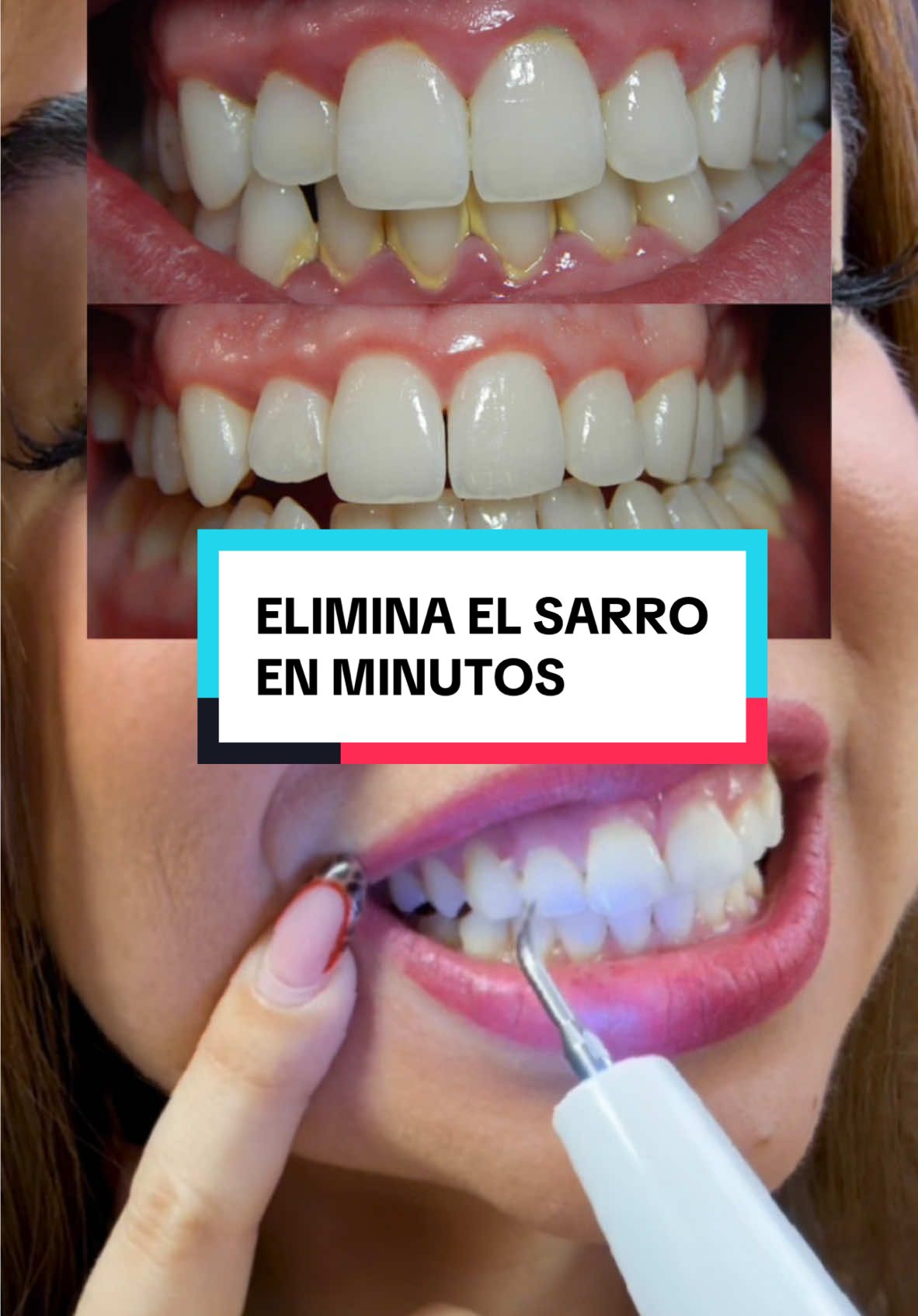 Sarros en tus dientes?? Es momento de tomar accion ‼️ #tiktokshopholidayhaul #teethcleaning #teethcare #dentalhygiene #sarro #sarrodental #teethtok #nbgrlvs #saludbucal #tartarremoval #trending #foryoupage #teeth 