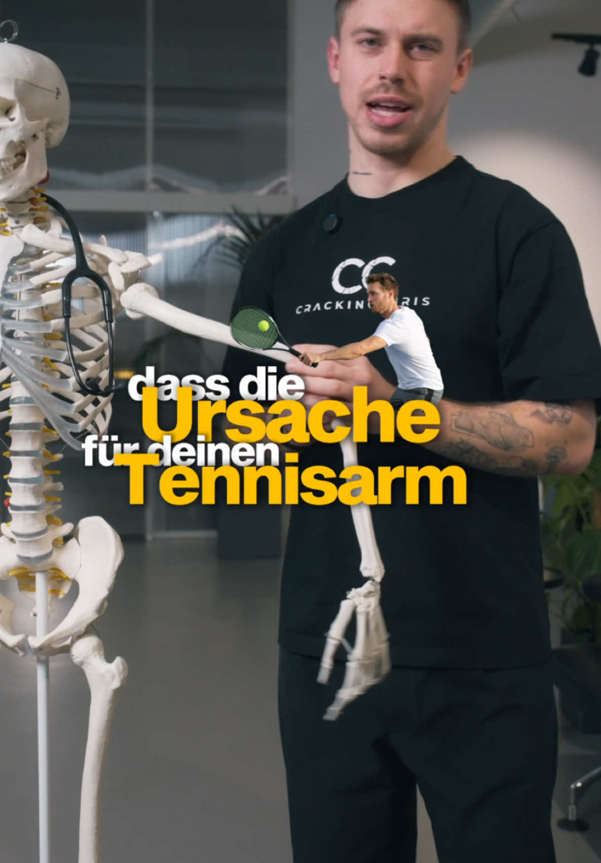 Ein Tennisarm ist quasi nicht anderes als ein Überlastungssyndrom der Unterarmmuskulatur. Dadurch entsteht eine Entzündung im Ansatzsehnenbereich und das äußert sich dann mit den bekannten Schmerzen am Ellenbogen (meistens bei Belastung).  Aber viele Patienten berichten, dass es gar keinen wirklich klaren Auslöser gab der für eine Überlastung gesorgt hat, sondern die Probleme schleichend aufgetreten sind. Das spricht häufig dafür, dass die Struktur einfach weniger versorgt wurde und dadurch auch durch die normale Belastung ausreichend, um die „minderversorgte“ Muskulatur zu überlasten. Wenn ihr mehrere Tage nicht genügend isst, seid ihr ja auch weniger Leistungsfähig oder?  Die Lösung in der Praxis: wieder die Versorgung herstellen! Und die kommt nun mal aus dem Bereich der Halswirbelsäule und durchläuft mehrere Engpässe.  Probiert die Übung unbedingt mal aus! 