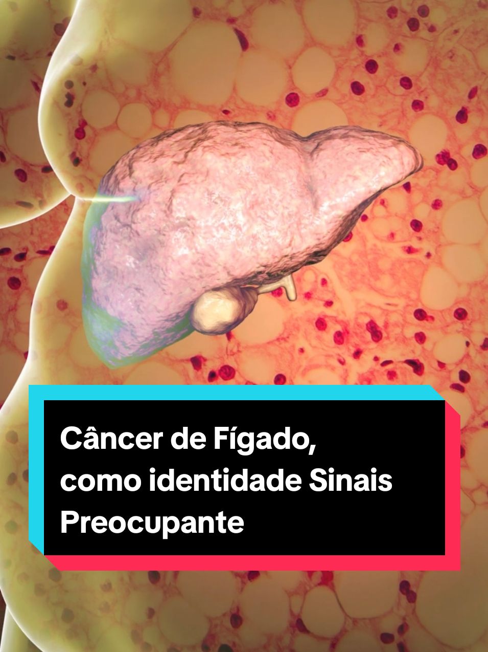 Câncer de Fígado, como identidade Sinais Preocupantes #figado #cancer #cancerdefigado 