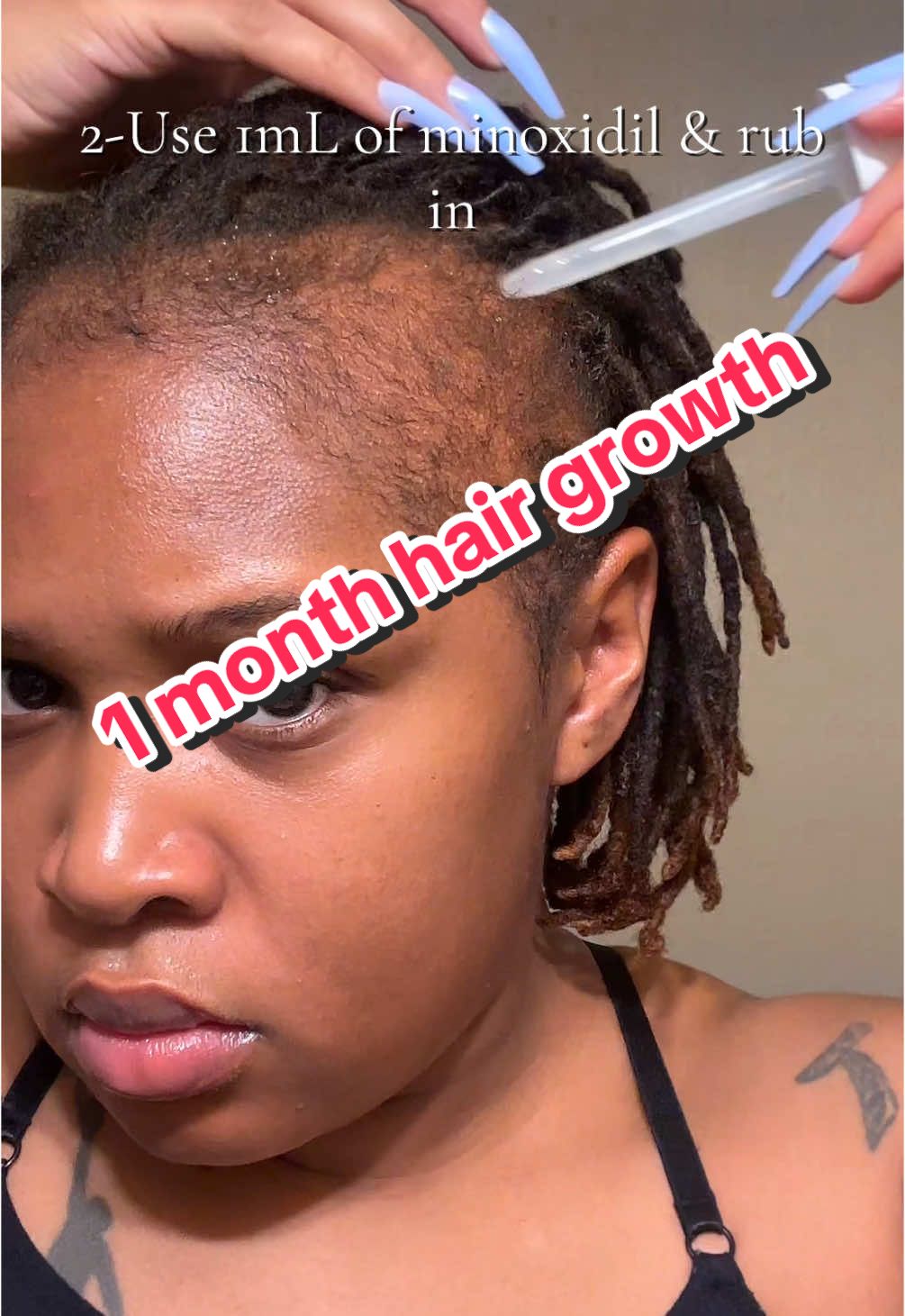 1 month results of growing my hair. I dont do this every night (because i be tired lol) but at least 5 times a week. And I only us minoxidil in the morning because the Bantana Oil smell is strong. Ive been dealing with alopecia since i was a child so to start seeing just the minimal growth makes me happy 🙌🏾 #minoxidil5 #growyouredgesback #howtouseminoxidilwomen #minoxidilresult #fyppppppppppppppp #hairtok #hairloss #hairlossremedy #bantanaoil 