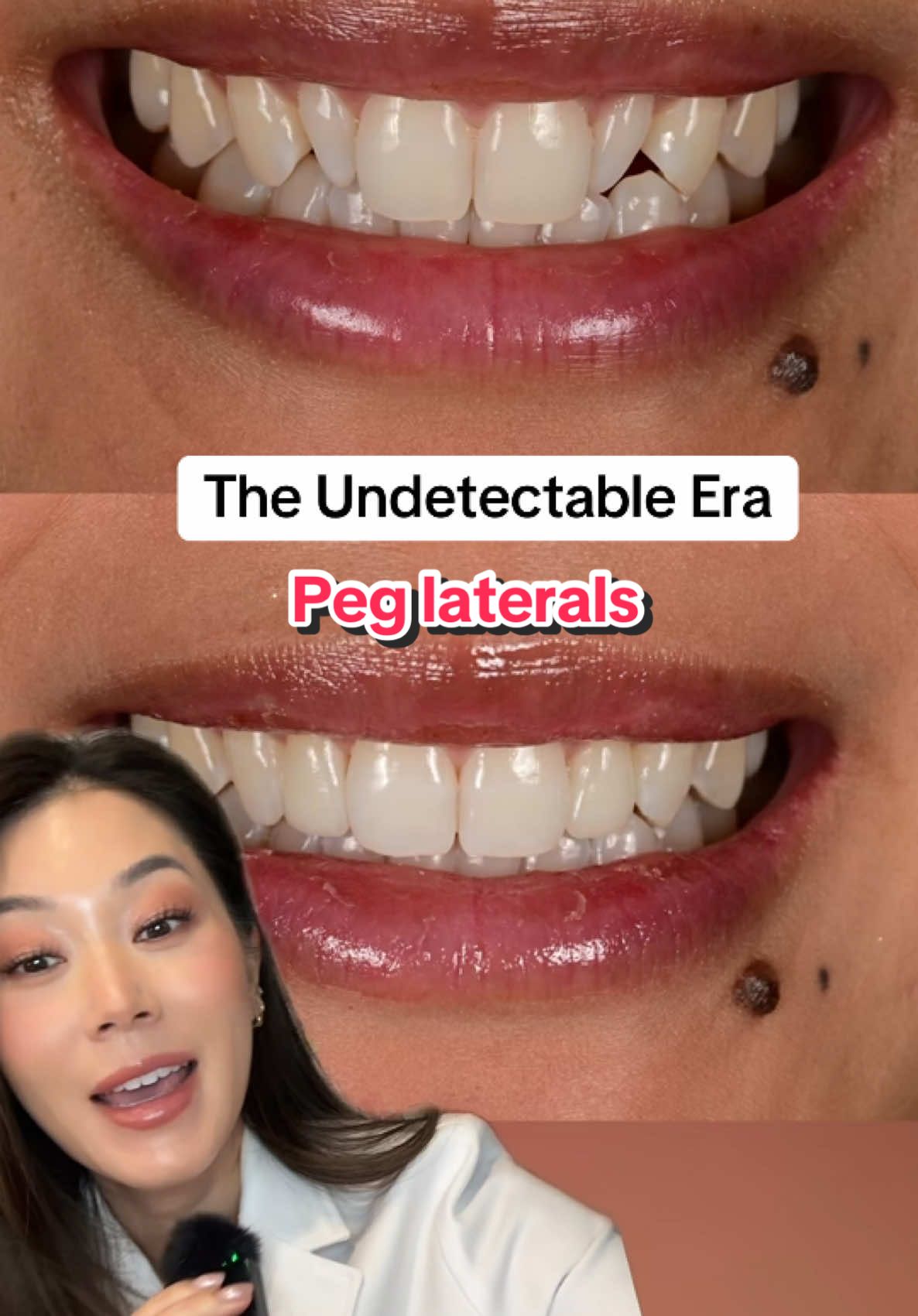 The power of cosmetic dentistry. Veneers get a bad reputation but when they are done thoughtfully they can be super conservstive and blend in with the surrounding smile. People think veneers are not just a slab of porcelain on a tooth but it really is an art. #noprepveneers #peglaterals #cosmeticdentist #bestveneers #porcelainveneers #veneers 