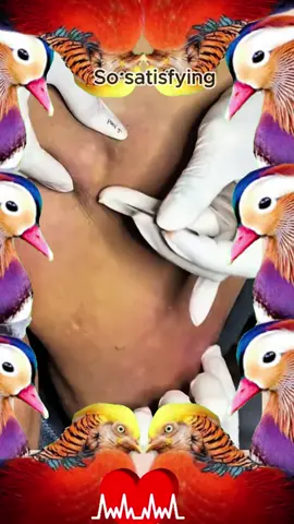 #squeezeyuk #satysfying #pimple #foryou #relax 