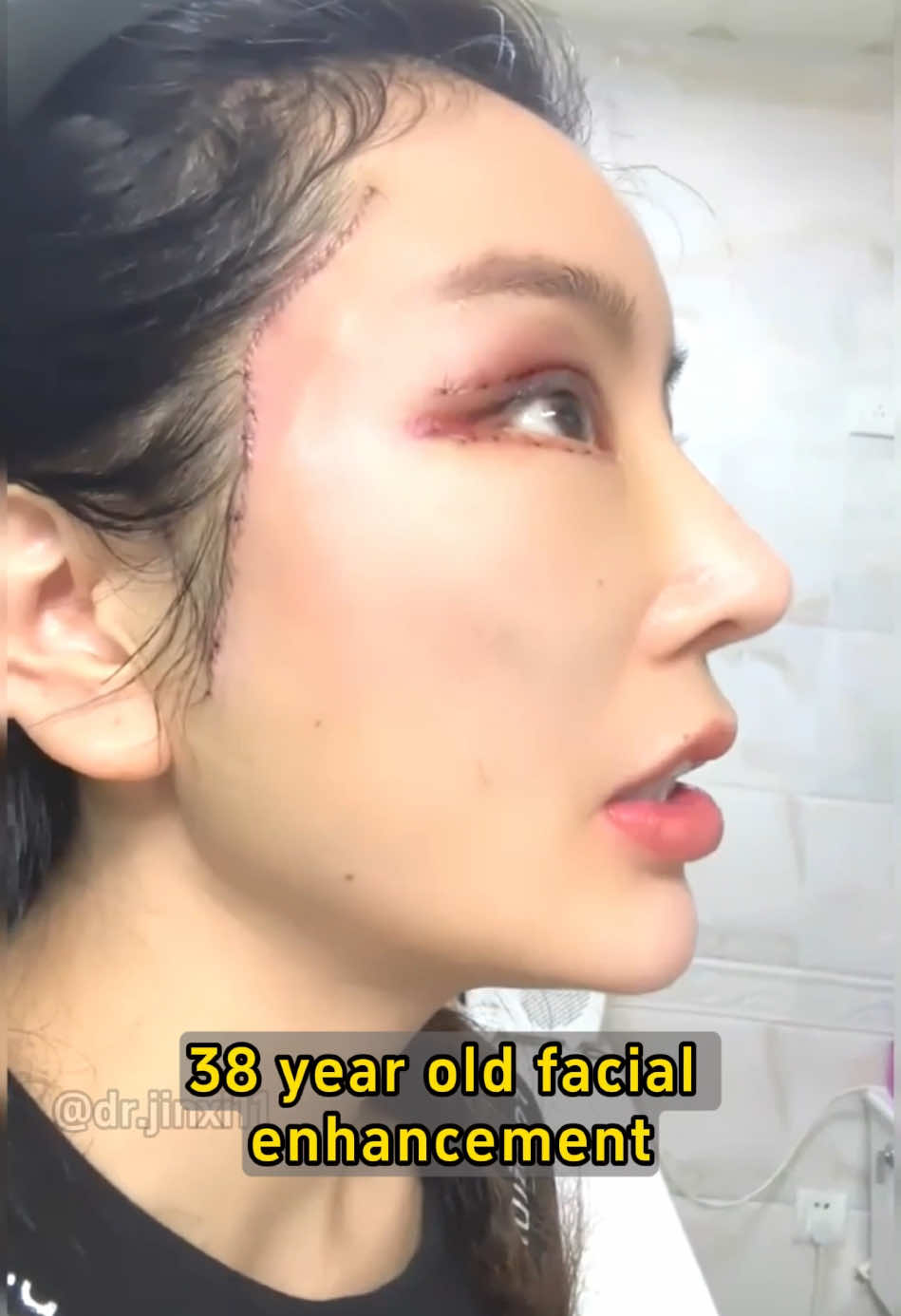 What do you think of the effect? #拉皮 #facelifting #antiaging 