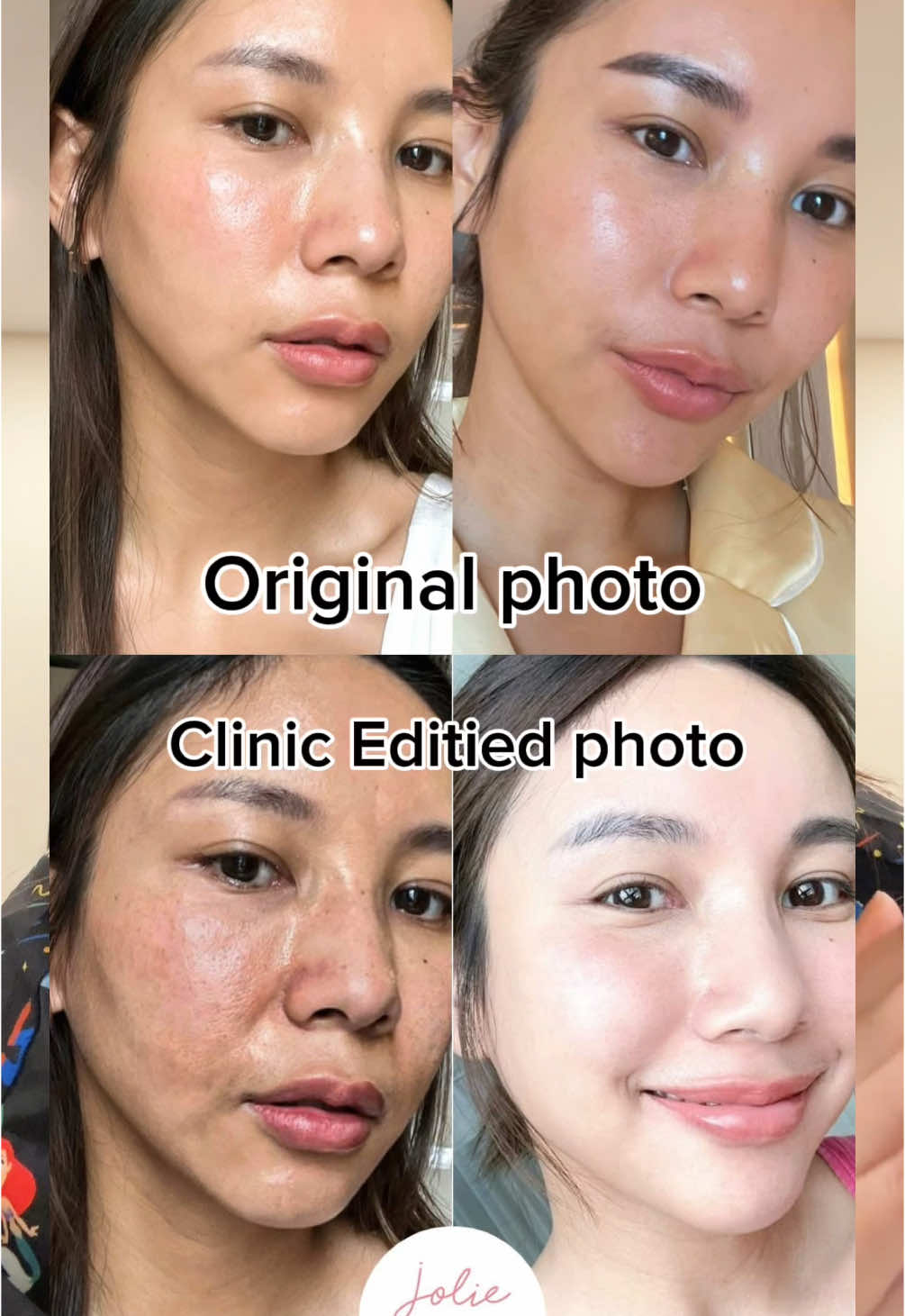 Jolie clinic 🤬😡 เอารูปไปใช้ไม่โกรธเท่าแต่งรูปให้น่าเกลียด 5555 #joliebeauty #philippines