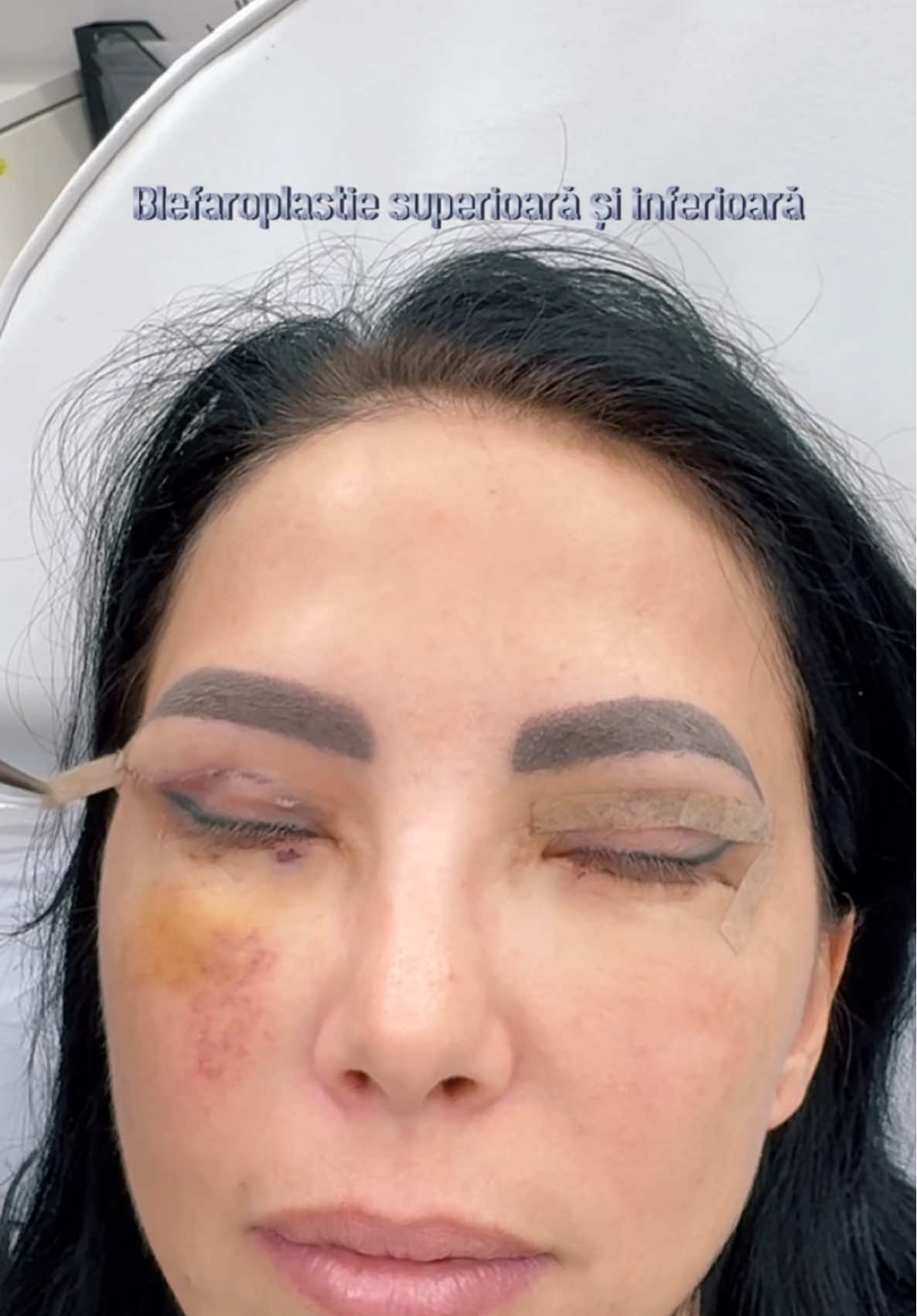 Iti amintesti cum arata pacienta noastra in urma cu o saptamana? #drlevymedicalcenter #bucurestiromania🇷🇴 #plasticsurgeonsoftiktok #plasticsurgery #blefaroplastica #blefaroplasty #transformation #blefaro #blefaroplastia 