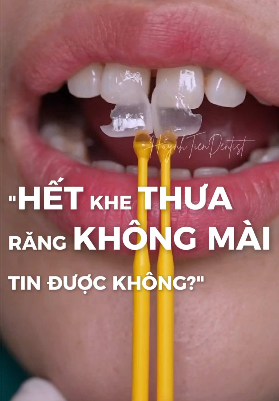 Một số người Á Đông tin rằng, khe thưa không tốt cho phong thuỷ, chủ nhân tướng răng thưa trong tướng số gặp nhiều sóng gió, thăng trầm, sự nghiệp cũng lận đận, phải tự lực cánh sinh bươn chải, thường phải xa xứ cầu danh.  Răng thưa tướng số không biết cách chi tiêu và quản lý tiền của, của cải sẽ trôi hết. Nữ răng thưa tướng số bần tiện. Với bác sĩ như mình, thì răng kín, đều thì đẹp hơn #huynhtiendentist #veneers #veneer #trám_răng_thưa #mặt_dán_sứ #lamdep 