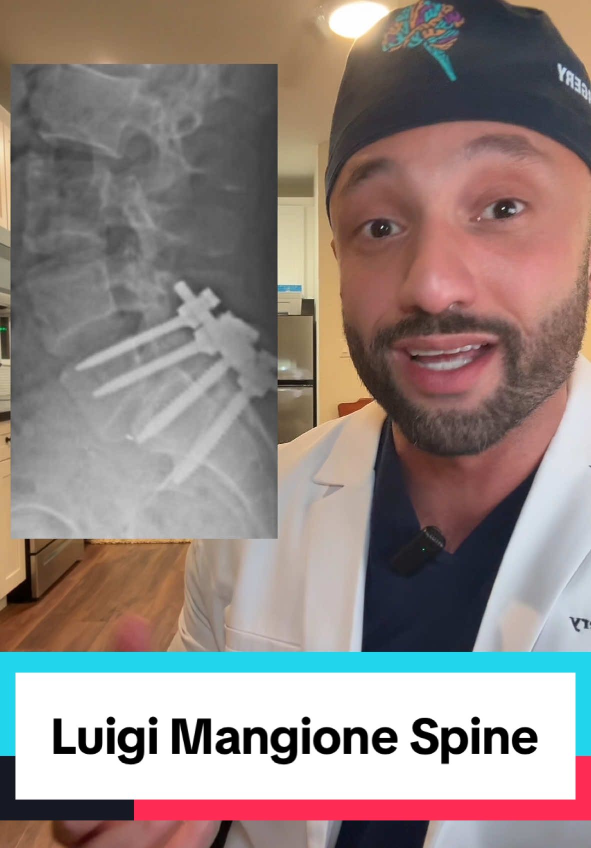 Luigi Mangione was reported to have had spine surgery and potentially had chronic back related issues. More information is needed.  #luigimangione #unitedhealthcare #ceo #medical #medtok #doctor #spine #spinehealth #backpain #backpainrelief  