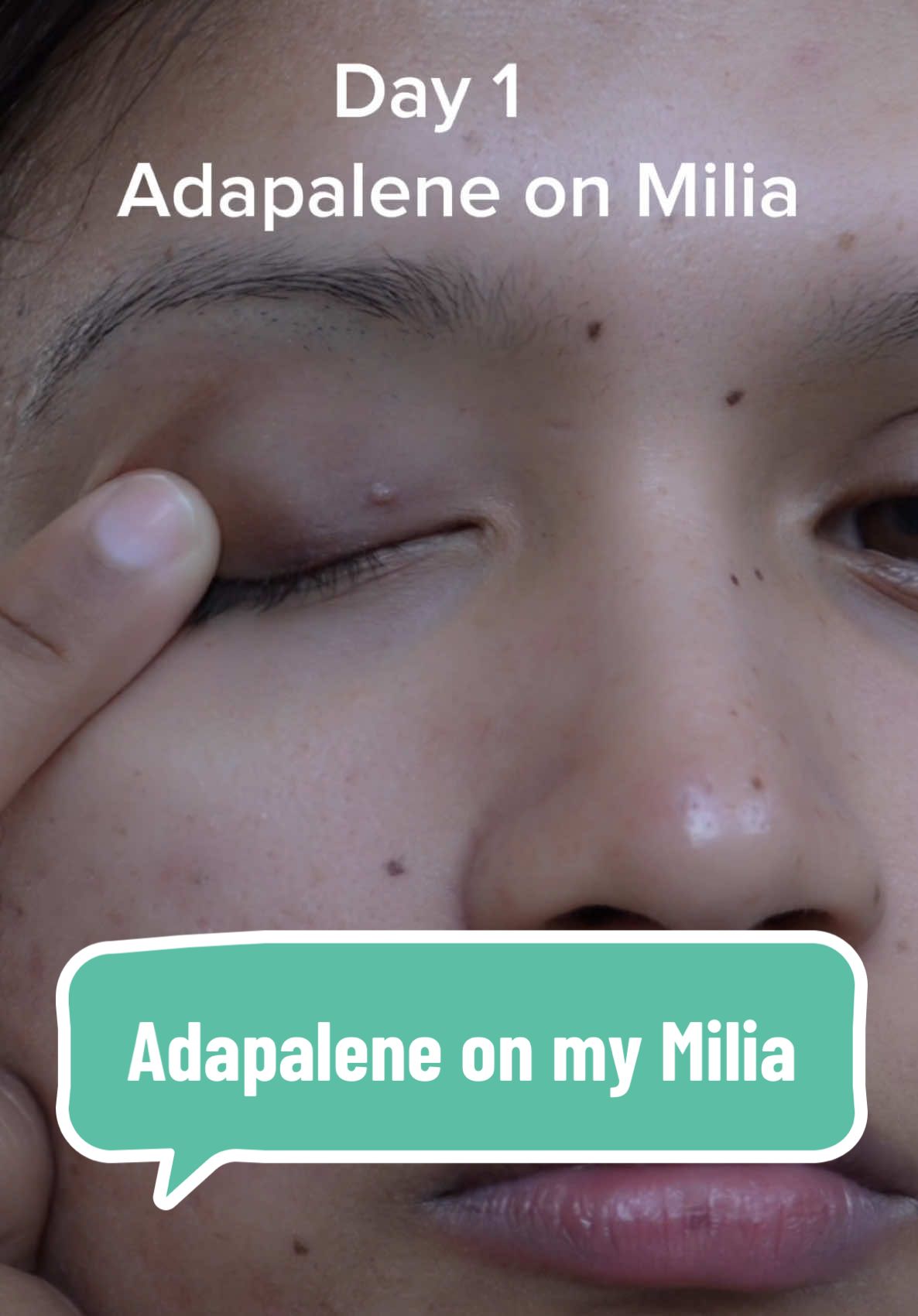 Adapalene on my Milia but everyone’s skin is different. Always check with your dermatologist before using it. ✌️ #adapalene #milia #miliaremoval #miliatreatment #miliaextraction #adapalenegel #beforeandafter 