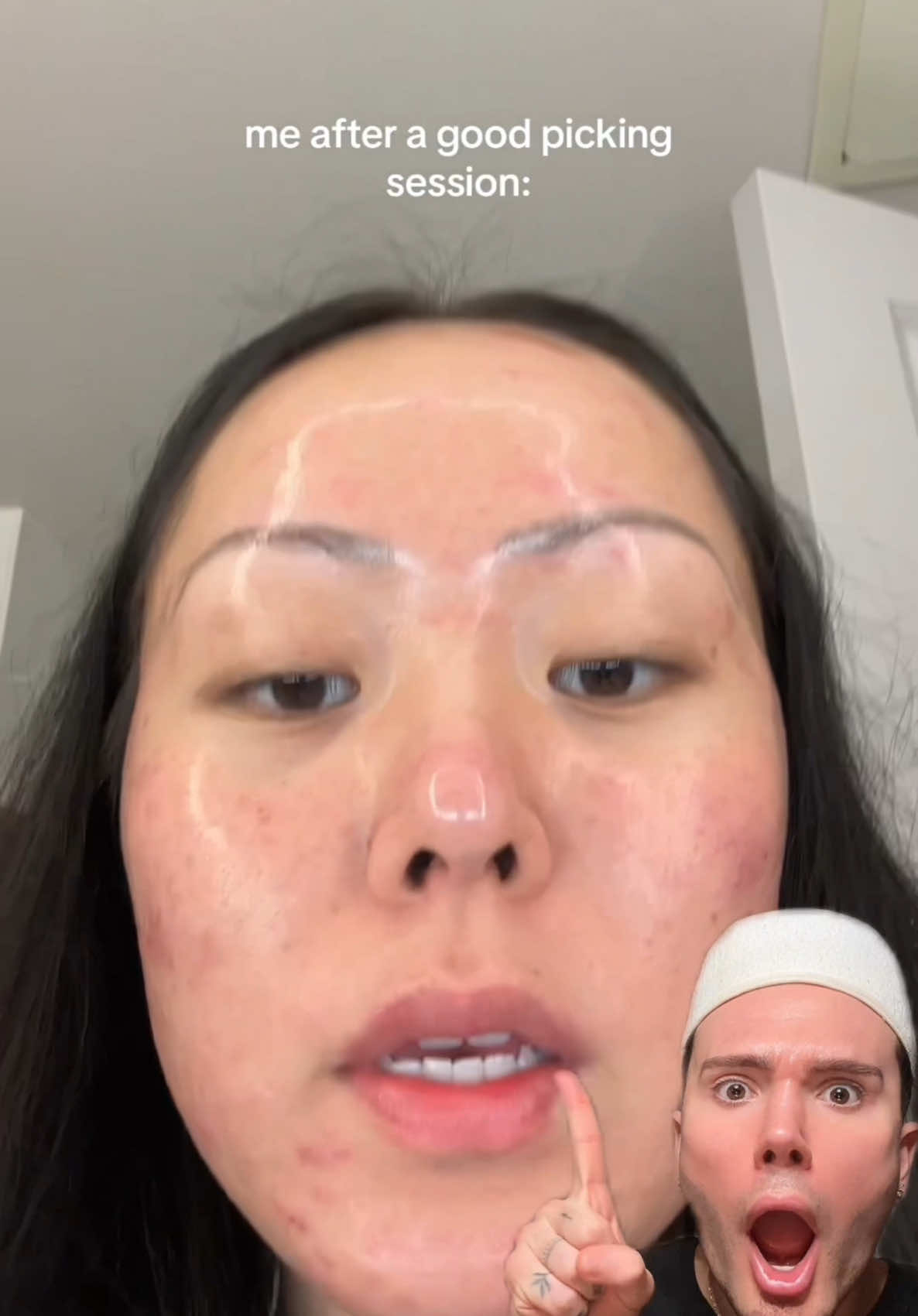 HOW TO FIX A BROKEN SKIN BARRIER!😱 #skinbarrier #SkinCare101 #skincareviral #skincaretiktok #skincarehacks #glowyskin #glassskin #acnefighter #acnescars 