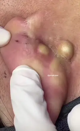 #creatorsearchinsights #pimplesremovalwithhand #remover #puntos #pimple #viral_video #foryour #fyp #fyppppppppppppppppppppppp #pourtoii #extractions #blackhead 