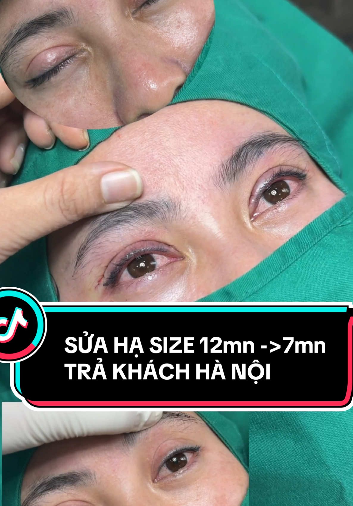 Case sửa hạ size trả khách HN hôm nay 11/12/2024 #viral #trendingvideo #dr #MH #tiểu_phẫu #Hiền_Triệu #TikTokAwardsVN #cắt_mí_đẹp_HN_SG #cắt_mí_phượng #lỗi_thẩm_mỹ #chuyên_sửa_mí_lỗi 