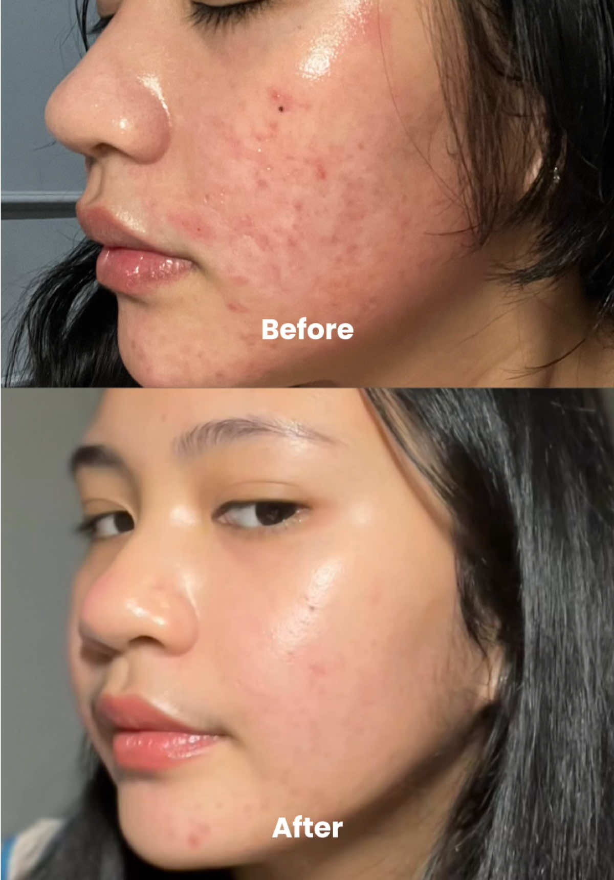 Ini udah jadi andalan aku kalo kulit mulai rewel, karena beneran se-cepet itu bgt buat ngeredain redness dan jerawat ❤️✨ #anua #anuaindonesia #cleasingoil #cleansingfoam #micellarwater #tone #hydratingtoner #doublecleansing #skincareroutine #kbeauty @ANUA Indonesia 