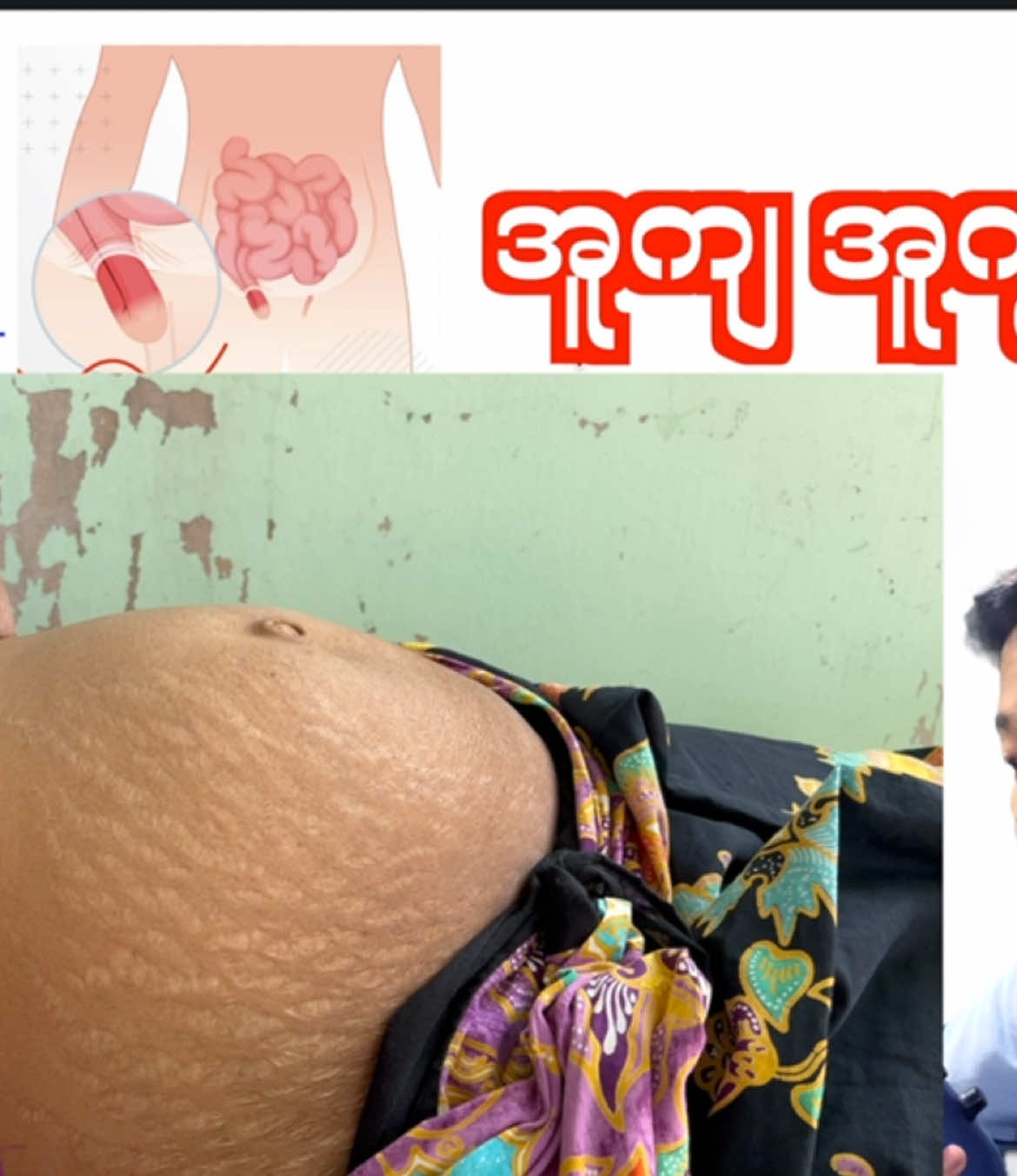 #အူကျ #အူကျွံခြင်း #hernia #drzawoo 