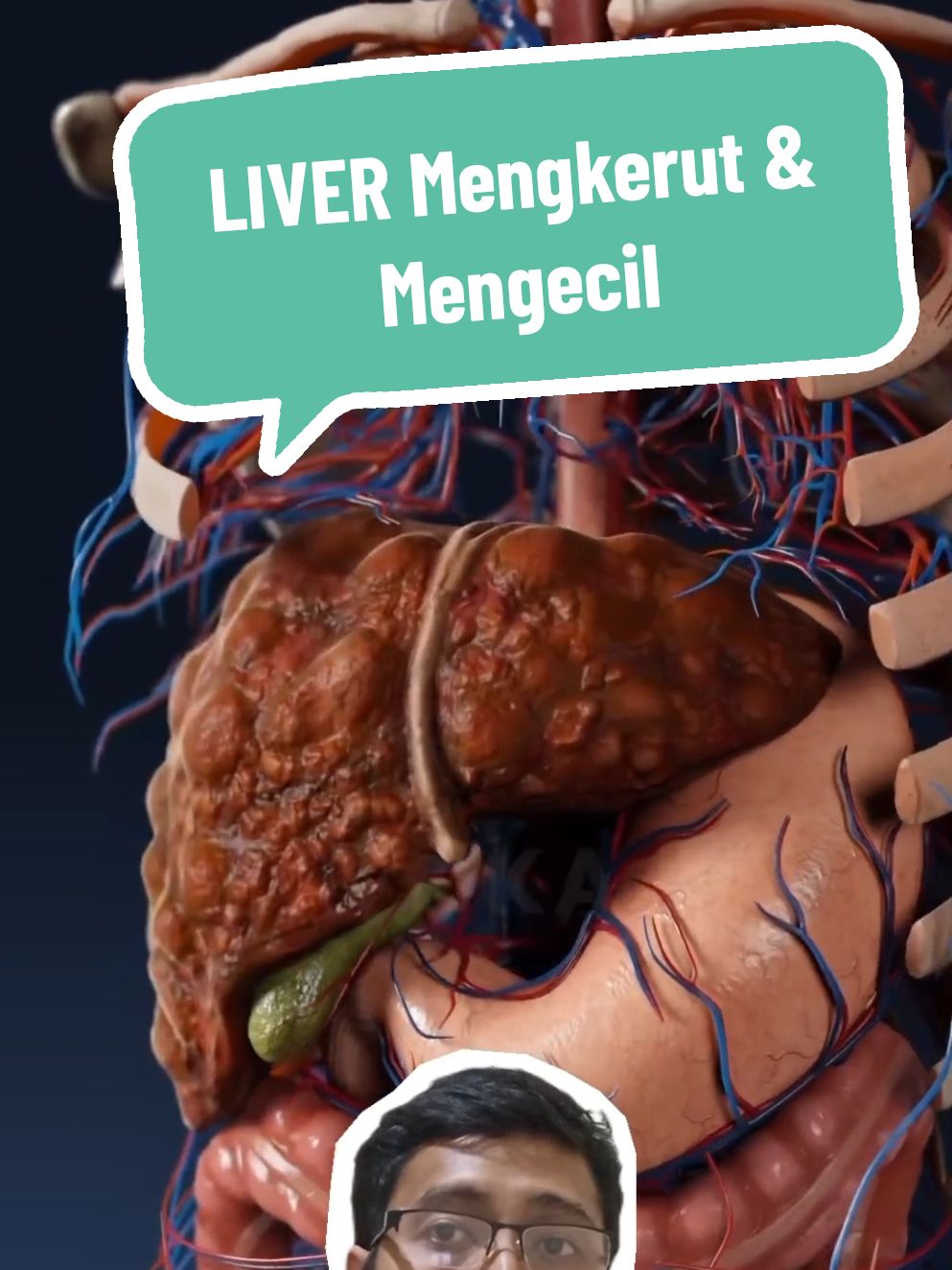 Liver bisa mengkerut dan mengecil dan rusak karena penyakit ini, efek dari hepatitis kronik, dan perlemakan hati kronis #sirosis #liver #hepatitis #hipertensiportal 