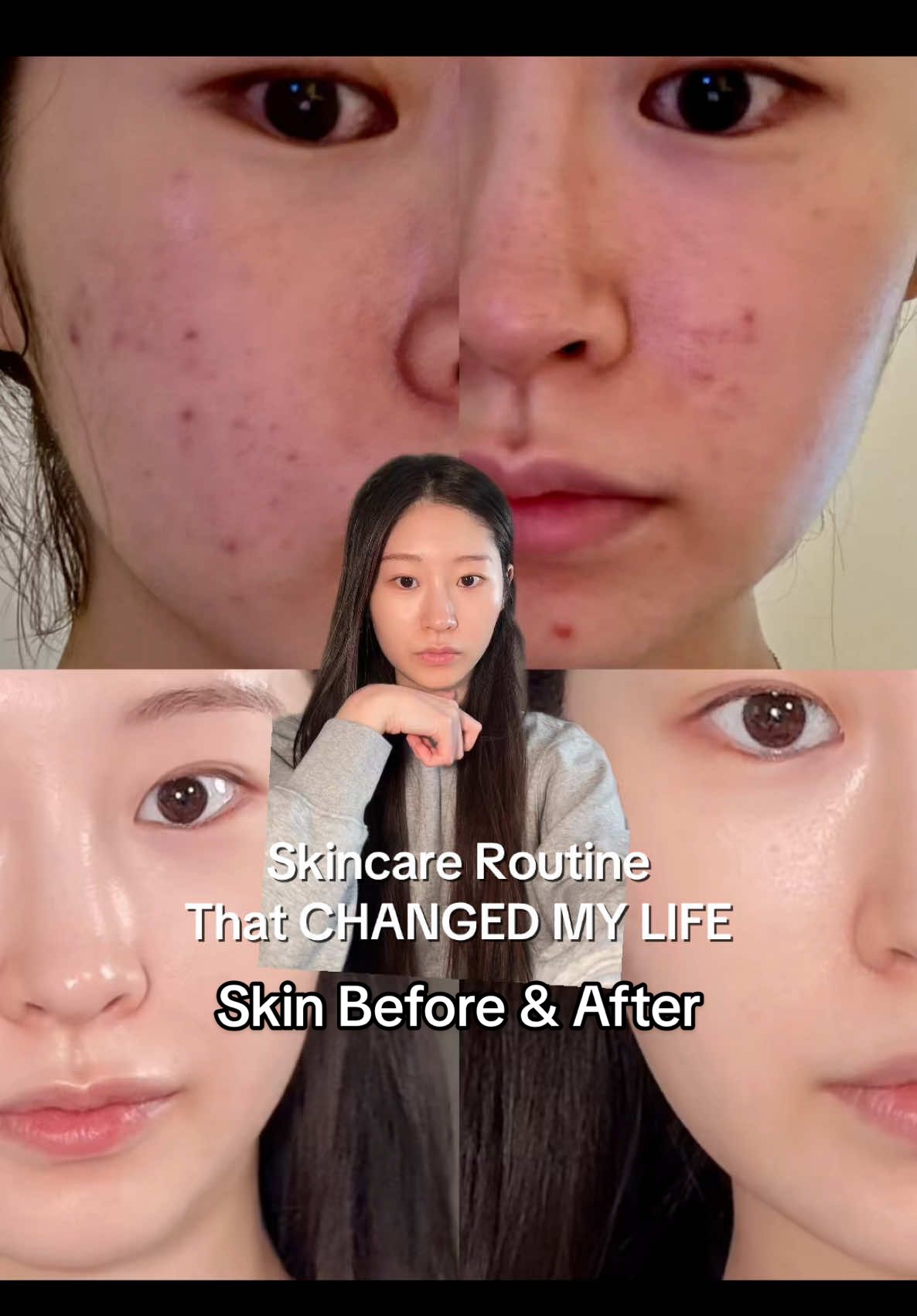 the way my skin TRANSFORMED‼️ #troubless #kbeauty #troublepatch #acnepatch #spotpatch #troublespot #acnecare #acnecosmetics #kbeautyskincare #koreanskincare #skincare #skincaretips #skincareroutine #SelfCare #zit #tjmaxx#greenscreen 