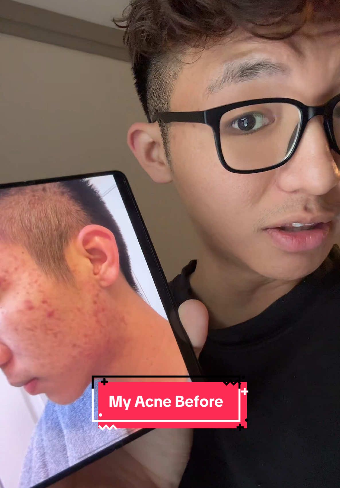 Yall, im so serious when i say this has been a life changing product for me 🥺❤️ #acne #skincare #theordinary #theordinaryglycolicacid #toner 