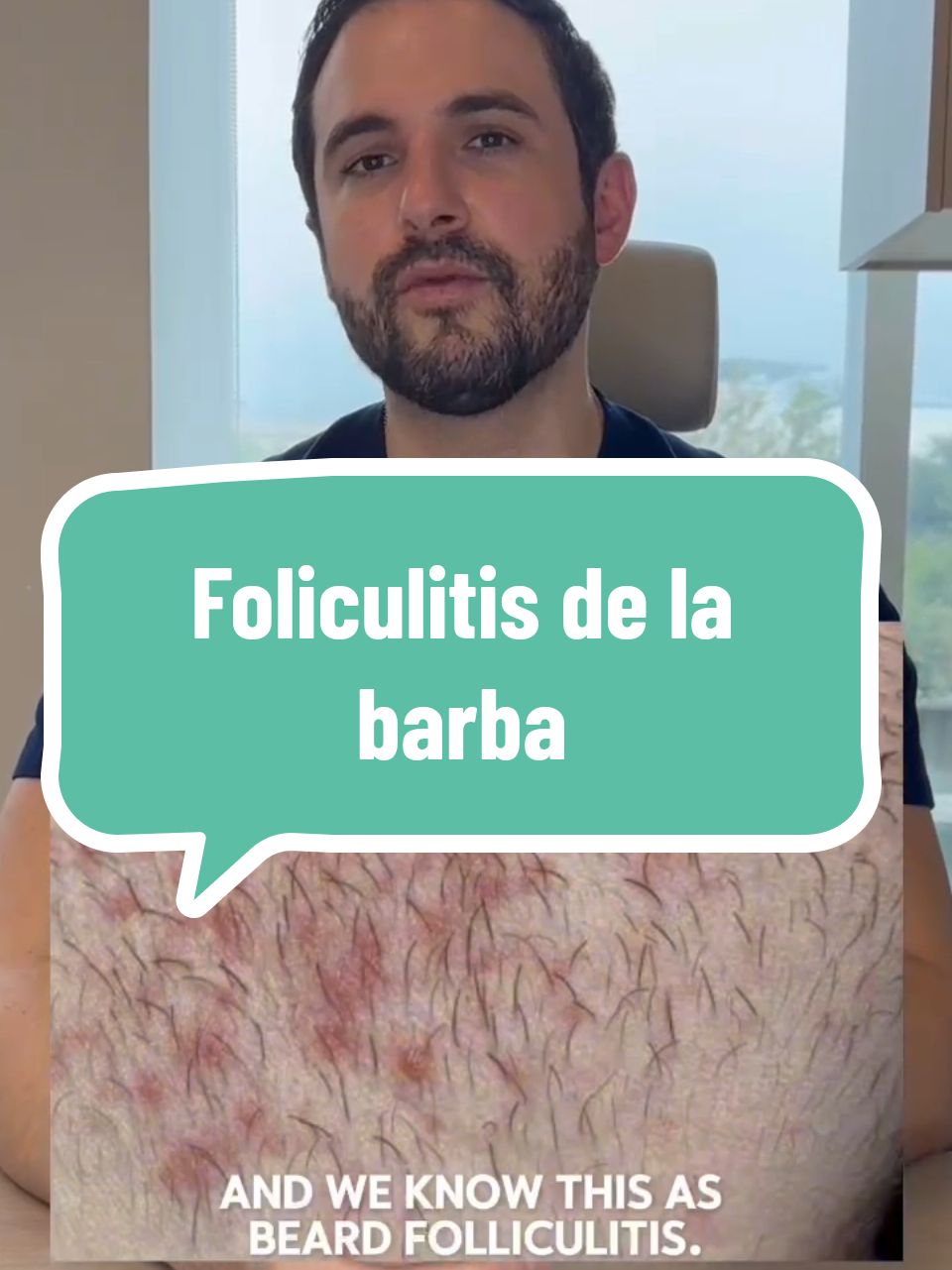 Foliculitis de la barba 🧔💆‍♂️ ¡Agenda tu cita ya! https://wa.me/5218181814704 📱WhatsApp 818 181 4704 📞Tel. 81 8333 2414 y 81 2557 7004 🏥Torre Ixco Av. Lazaro Cárdenas 1010, planta baja local 8. Col. Residencial San Agustín, San Pedro Garza García, N.L.  Permiso COFEPRIS 2319032002A00139  Cédula Profesional 4468059 UANL Cédula de Especialidad 6109945 UANL  #barba #foliculitis #granos  #cuidadodelabarba #pielsana #cuidadodelcabello #uñas   #cuidadodelapiel #skincare #dermatologiamonterrey #dermatologo #dermatologia #dermatologomonterrey #ondermclinic #clinicadermatologica #Monterrey 