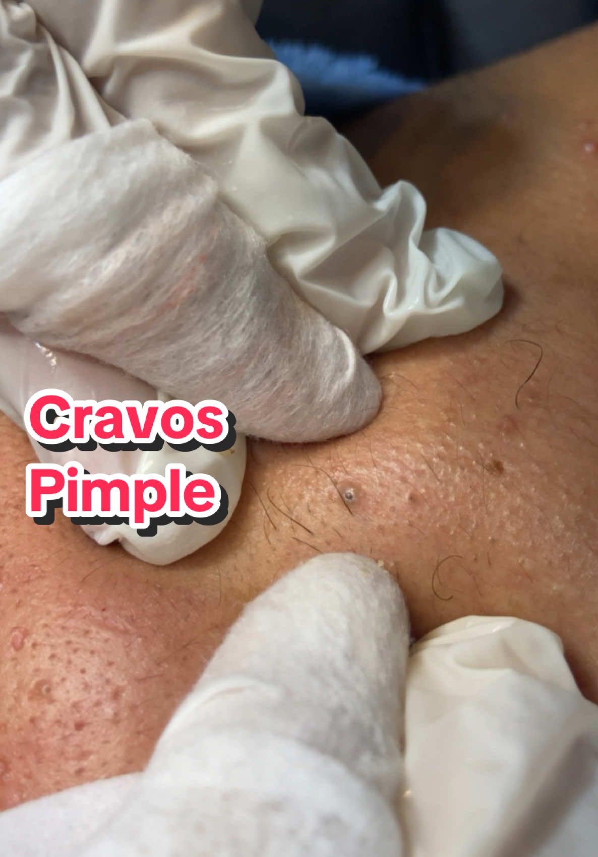 #cravos #fyp #fypp #fypdong #fyppp #com #sem #parte1 #pimple #pimplepop #pimples #pimplepopper #removal #viral_video #viralvideos #videos #tirana #limpieza #limpa #pele #luvas #esteticafacial #blackhead #puntosnegros #puntos #sandra #satysfying #tik #estetik #brasil #minasgerais #egypt #arabicsong #indirectas #tiktokindia_ 