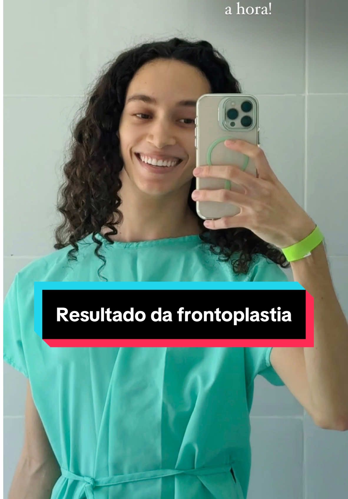 Replying to @Ana Carolina Chá revelação da minha testa nova 🤯 Você não imagina o prazer de finalmente poder cuidar novamente dos meus cachos e recuperar minha dignidade! Por mais “simples” que a frontoplastia possa parecer em comparação a outras cirurgias, é importante considerar diversos fatores, como a cicatriz na testa, por exemplo. Não estou aqui para incentivar ninguém a fazer nada — pensem bem antes de se submeter a qualquer procedimento estético. Agora me conta: o que você achou? #testa #testagrande #frontoplastia 