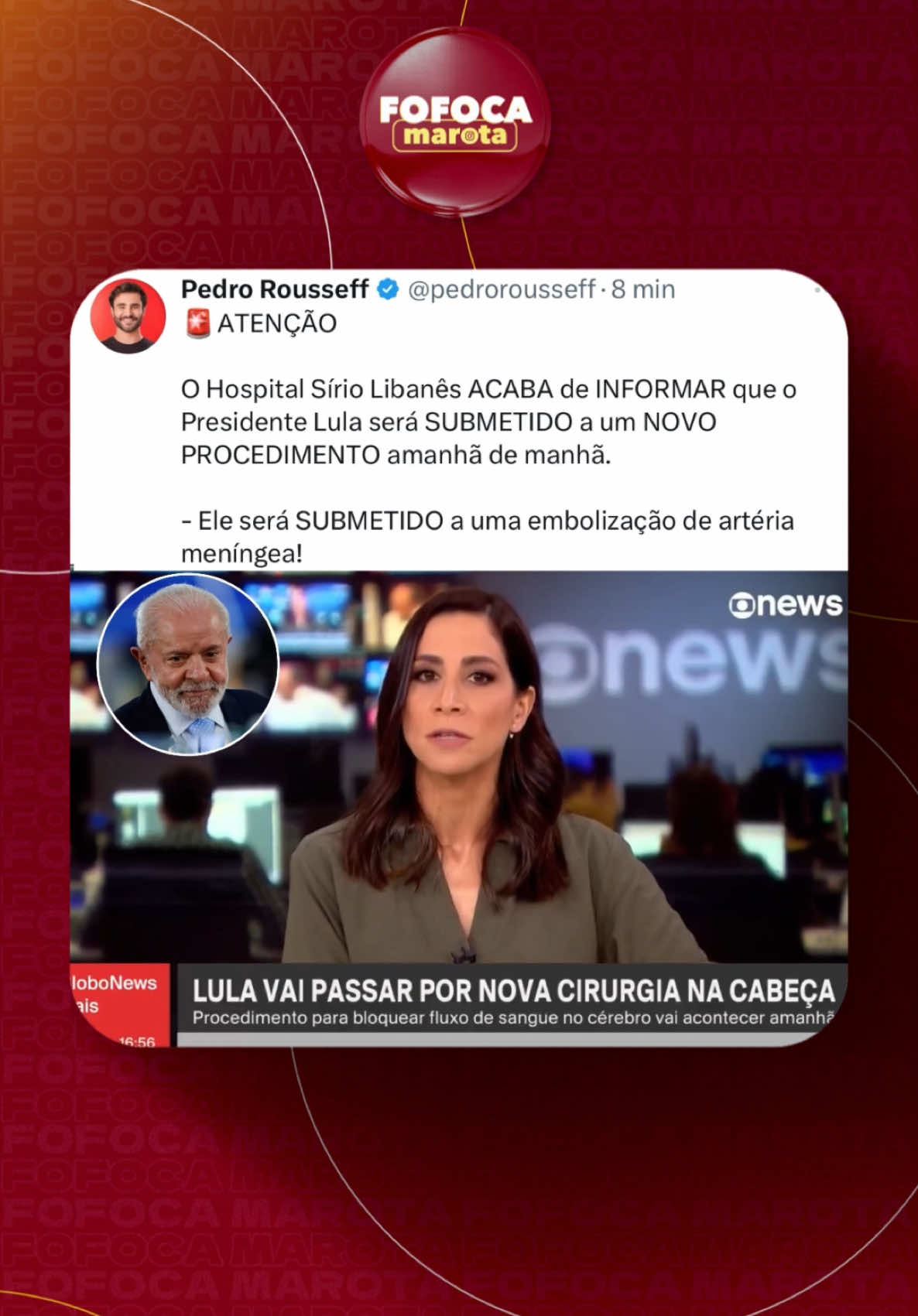 🚨Lula irá passar por nova CIRURGIA nessa quinta-feira para bloquear fluxo de sangue no cérebro. #fofocamarota #fy #lula Reprodução: Globo News 