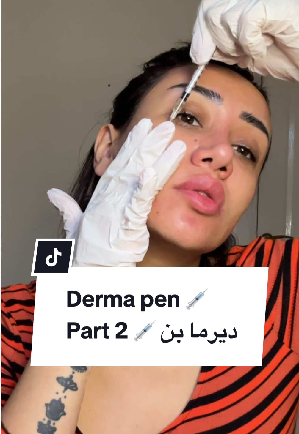 بشره نضره و صافيه في إجراء بسيط (الديرما بن) 💉🫶🏻 Part 2 . . . . #dermapen #dermapenathome #microneedling #derma #dermastamp #fusion #fusionmeso #mesotherapy #stepbystep #cosmotolgy #ديرما #ديرما_بن #البشره #ميزوثيرابي #عيادات_تجميل #تجميل #drpen 