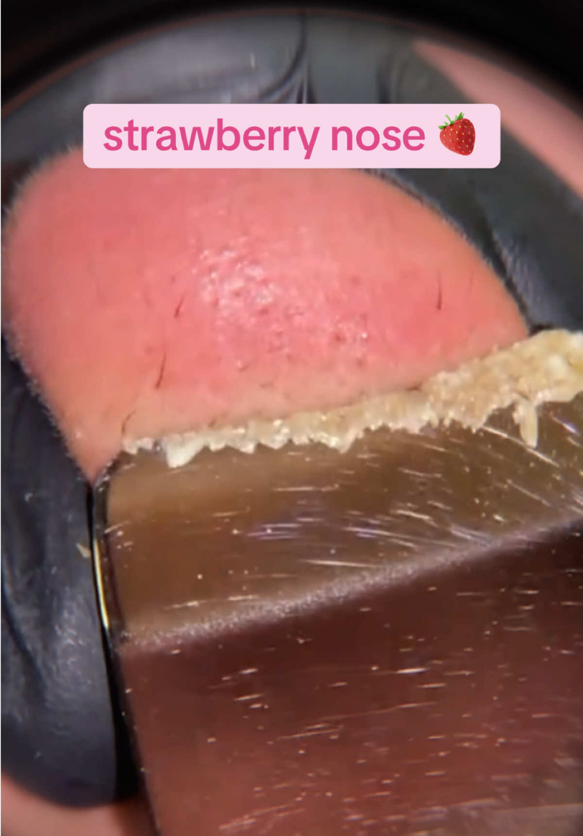 🍓🍓🍓#blackhead #supersatisfying #pimplepop #extractionsatisfaciton 